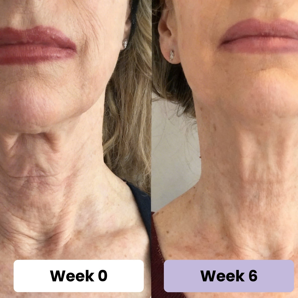 4. It's The Post-Weight Loss Neck Solution Women Have Been Waiting For